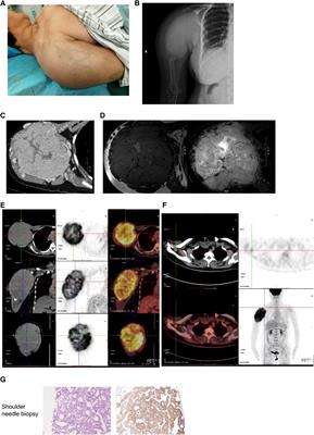 Case Report: A papillary thyroid microcarcinoma patient with skip lymph node metastasis and multiple distant metastasis